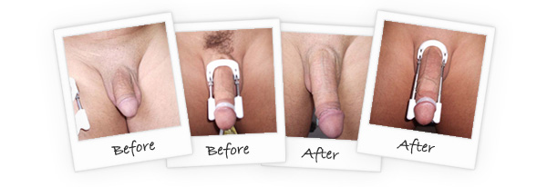 Pro Extender - Alat Pembesar Penis Modern